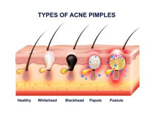Colored skin acne anatomy composition with types of acne pimples before and after 