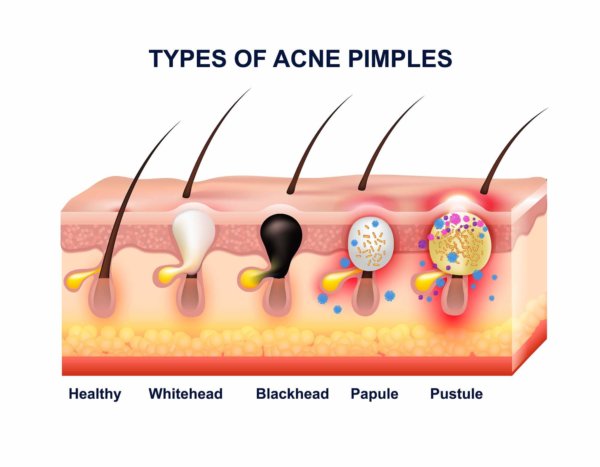 The Different Types of Acne: What Type of Bumps and Blemishes are ...